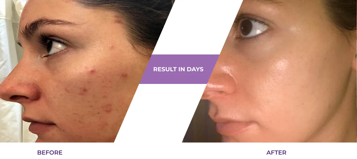 Before and after using Kiss serum: acne marks visibly reduced